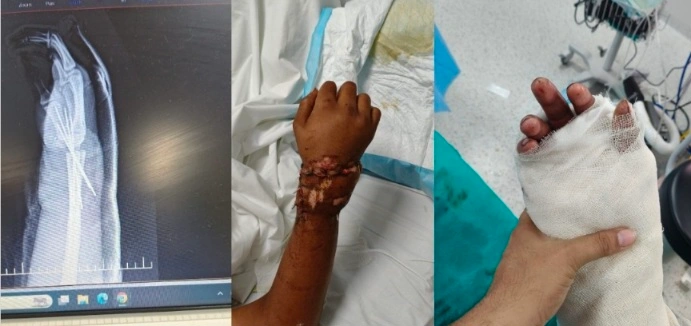 Yashoda Medicity Hospital : 7 घंटे की जटिल माइक्रोसर्जरी से 18 वर्षीय युवक का कटा हाथ फिर जोड़ा, यशोदा मेडिसिटी के डॉक्टरों को मिली सफलता, कंस्ट्रक्शन साइट हादसे में कलाई से पूरी तरह कट गया था दाहिना हाथ, माइक्रोसर्जरी से रक्त वाहिकाओं, नसों और टेंडन्स को जोड़ा, इमरजेंसी में तुरंत शुरू हुई विशेषज्ञों की टीम, “पूरी तरह कटे हाथ को जोड़ना समय के साथ दौड़ जैसा” 2 Screenshot 20260810 163859 PicCollage converted 1